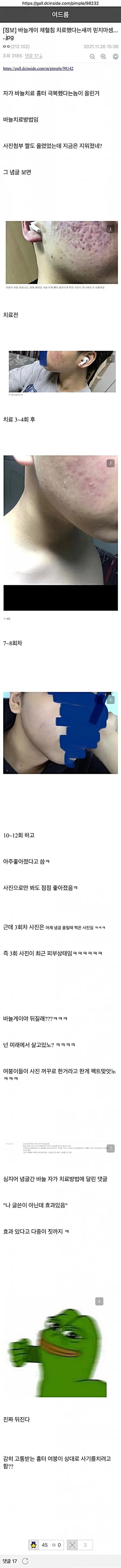 여드름은 고통이다